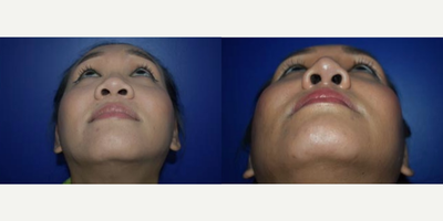 Rhinoplasty before and after photo