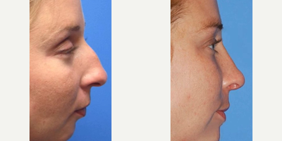 Rhinoplasty before and after photo