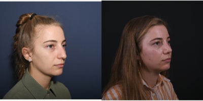 Rhinoplasty before and after photo