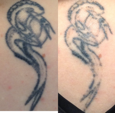 Tattoo Removal before and after photo