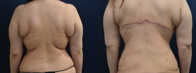 Body Lift before and after photo