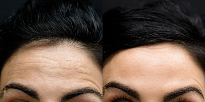 Botox before and after photo