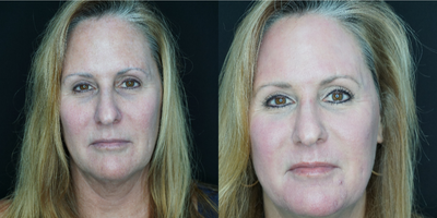 CO2 Laser before and after photo