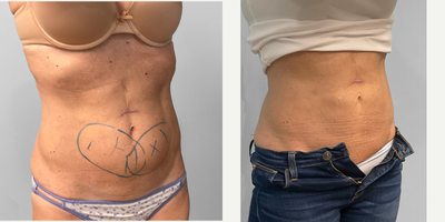 CoolSculpting before and after photo