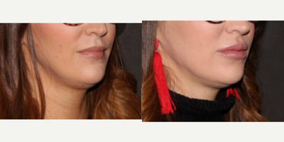 Restylane before and after photo