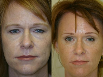 Brow Lift before and after photo