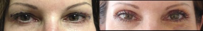 Eyelid Surgery before and after photo