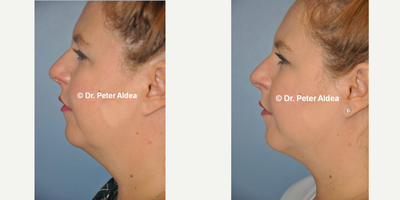 Liposuction before and after photo