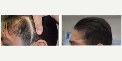 Scalp Micropigmentation before and after photo