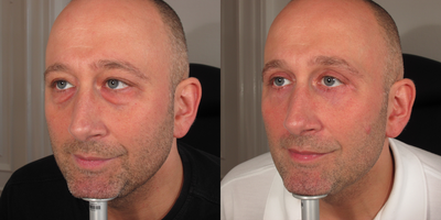 CO2 Laser before and after photo