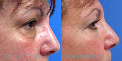 Eyelid Surgery before and after photo