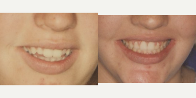 Invisalign before and after photo