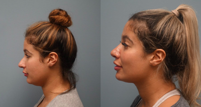 Rhinoplasty before and after photo