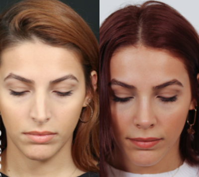 Rhinoplasty before and after photo