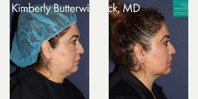 ThermiTight before and after photo