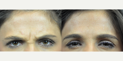 Botox before and after photo