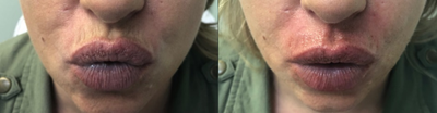 Belotero before and after photo
