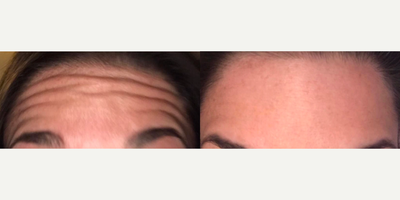 Botox before and after photo