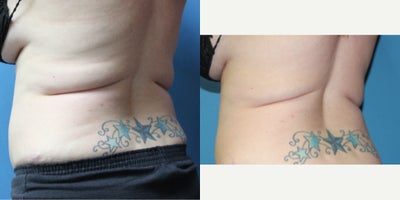 CoolSculpting before and after photo