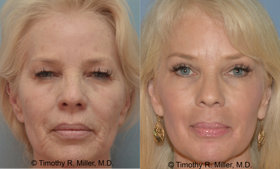 Laser Resurfacing before and after photo