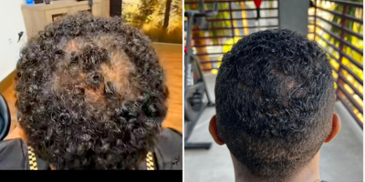 PRP for Hair Loss before and after photo