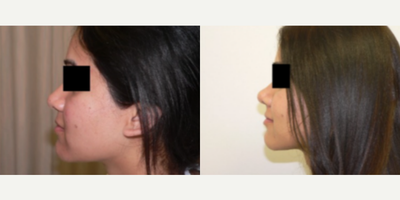 Rhinoplasty before and after photo