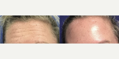 Botox before and after photo
