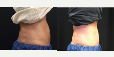 CoolSculpting before and after photo