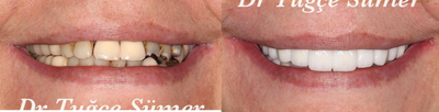 Dental Crown before and after photo