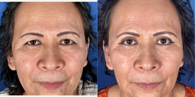 Eyelid Surgery before and after photo