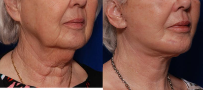 Facelift before and after photo