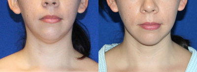 Liposuction before and after photo