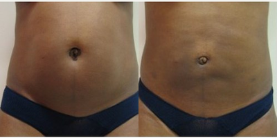 Liposuction before and after photo