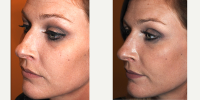Nonsurgical Nose Job before and after photo