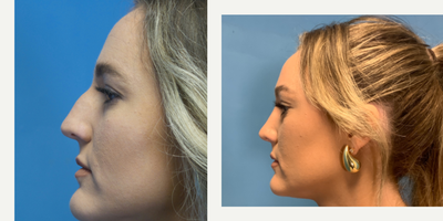 Rhinoplasty before and after photo