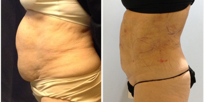 Smart Lipo before and after photo