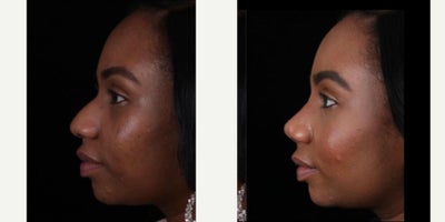 African American Rhinoplasty before and after photo