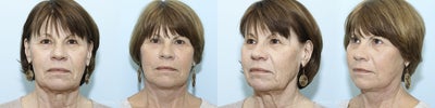 Facelift before and after photo