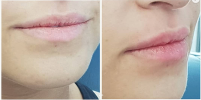 Juvederm before and after photo