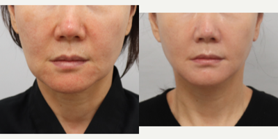 Neck Lift before and after photo