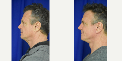 Neck Lift before and after photo