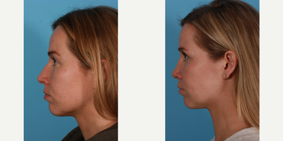 Rhinoplasty before and after photo