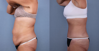 Tummy Tuck before and after photo