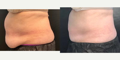 CoolSculpting before and after photo