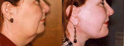 Facelift before and after photo