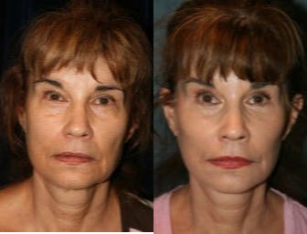Facelift before and after photo