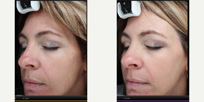 Halo Laser before and after photo