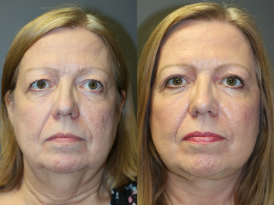 Neck Lift before and after photo
