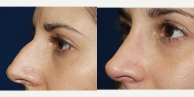 Rhinoplasty before and after photo