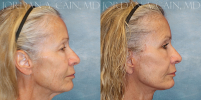 Eyelid Surgery before and after photo